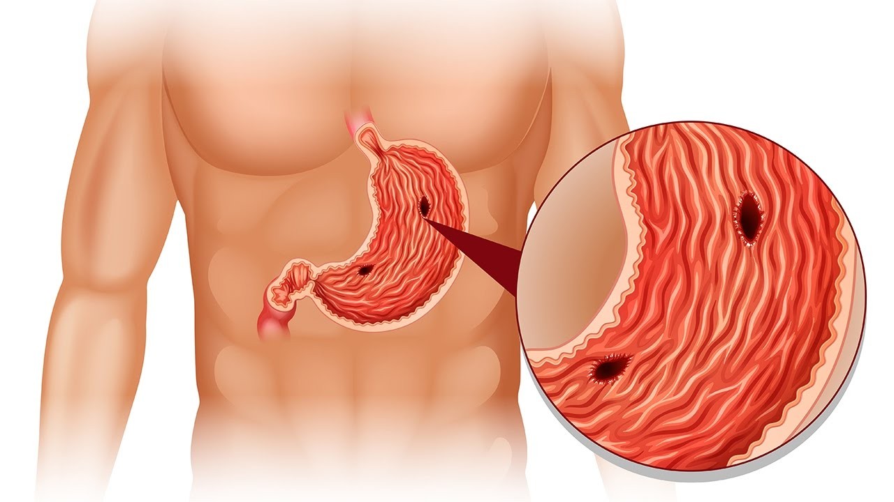 Intestinal perforation image