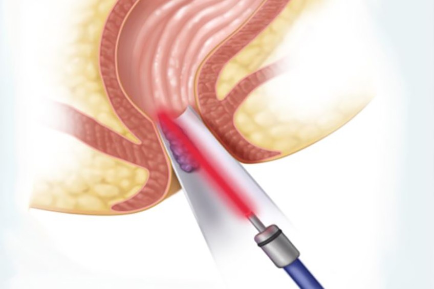 Hemorrhoids with laser image